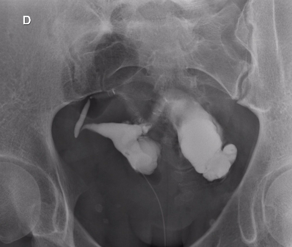 Hidrossalpinge bilateral