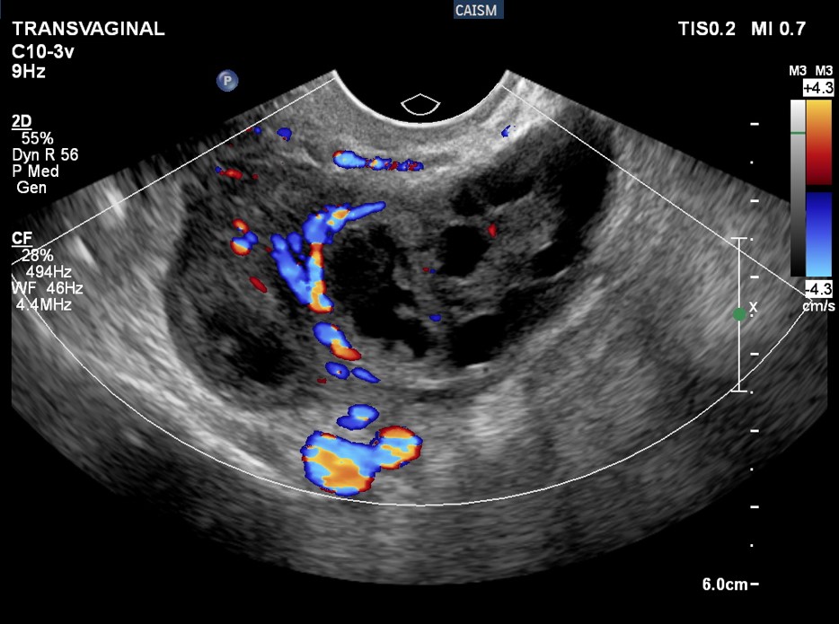 Piossalpinge - Diferenciação por imagem entre a piossalpinge e o abscesso tubo ovariano.