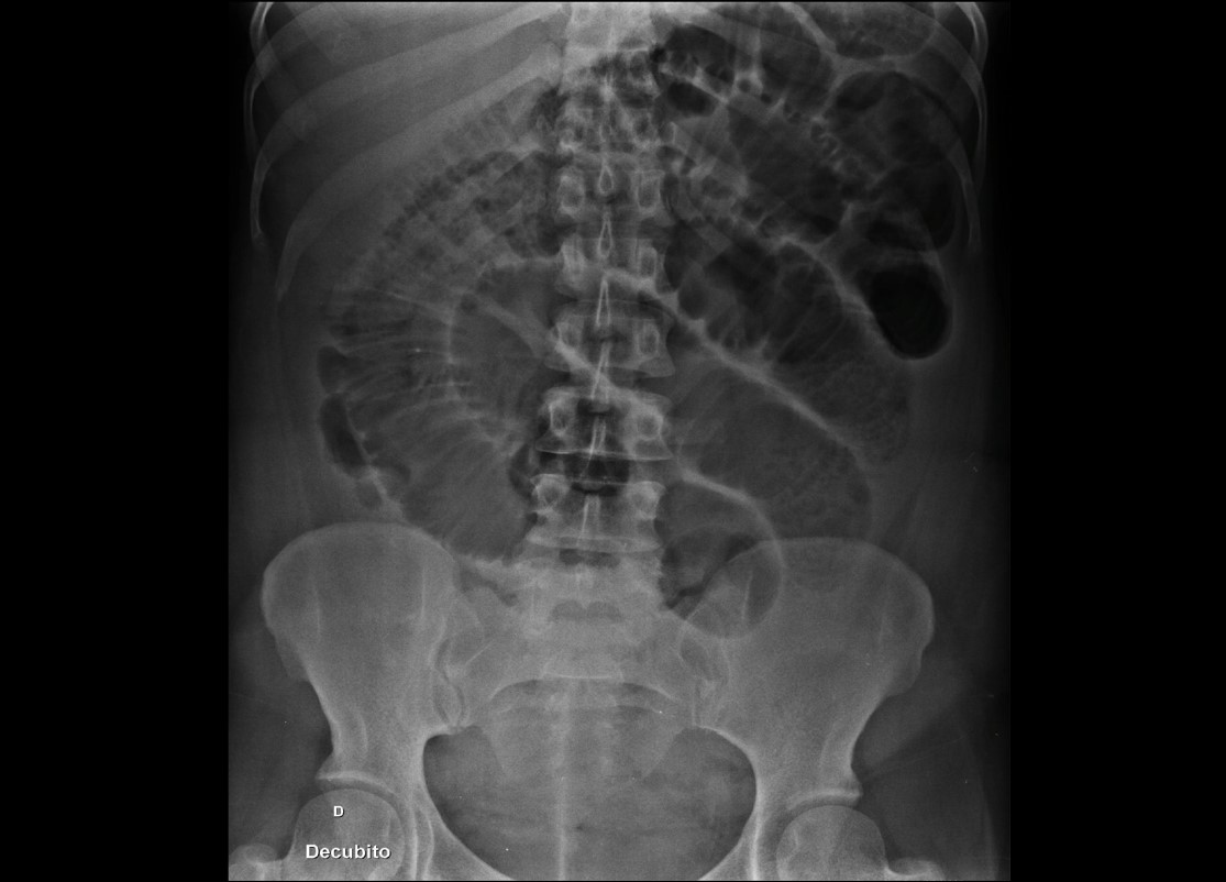 Abdômen agudo obstrutivo pós-operatório