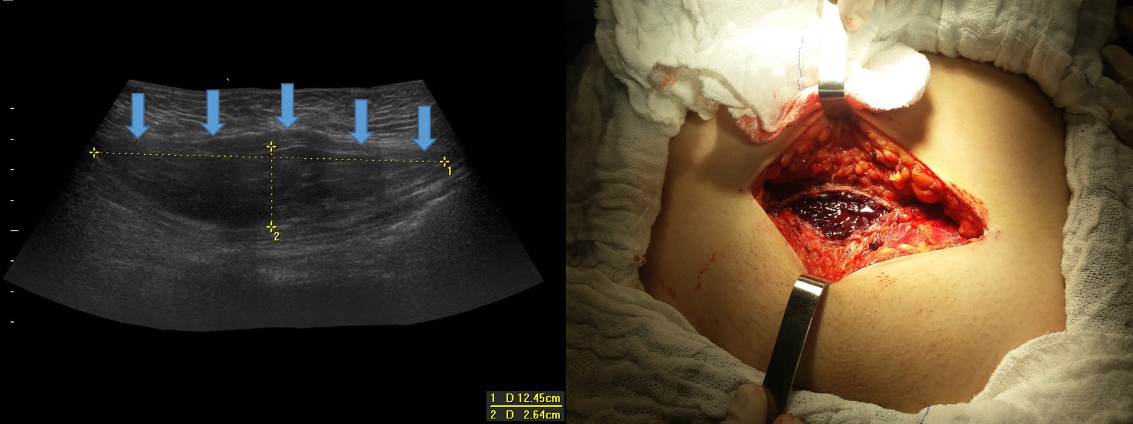 Abdominal wall sub-aponeurotic hematoma