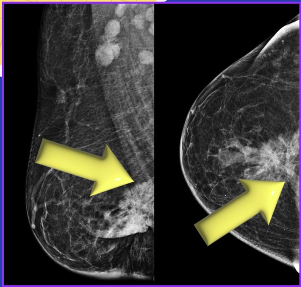 Achados mamográficos de progressão de câncer de mama para o músculo peitoral maior