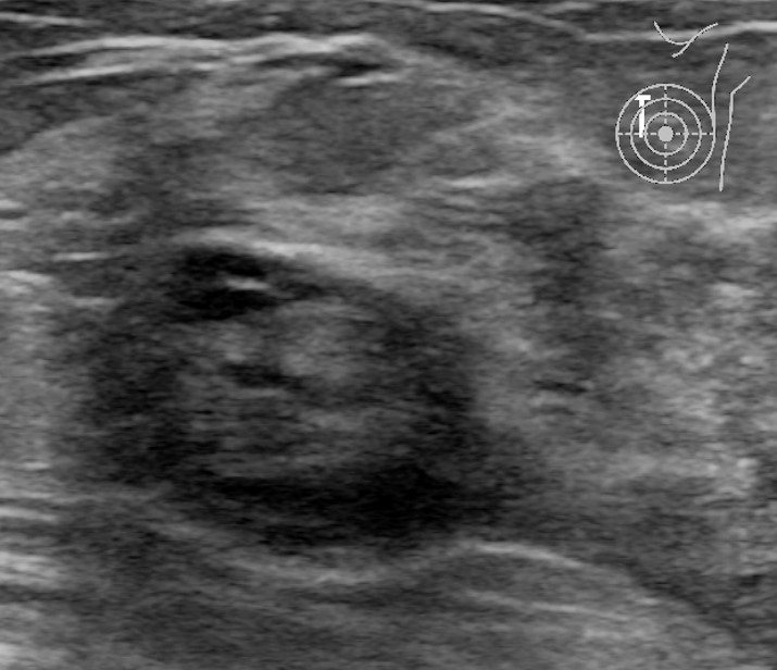 Achados ultrassonográficos do adenoma lactante