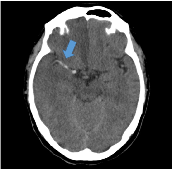 Acm hiperdensa - avc isquêmico
