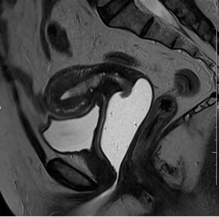 Adenocarcinoma de endométrio exteriorizando-se pelo orifío externo do colo uterino