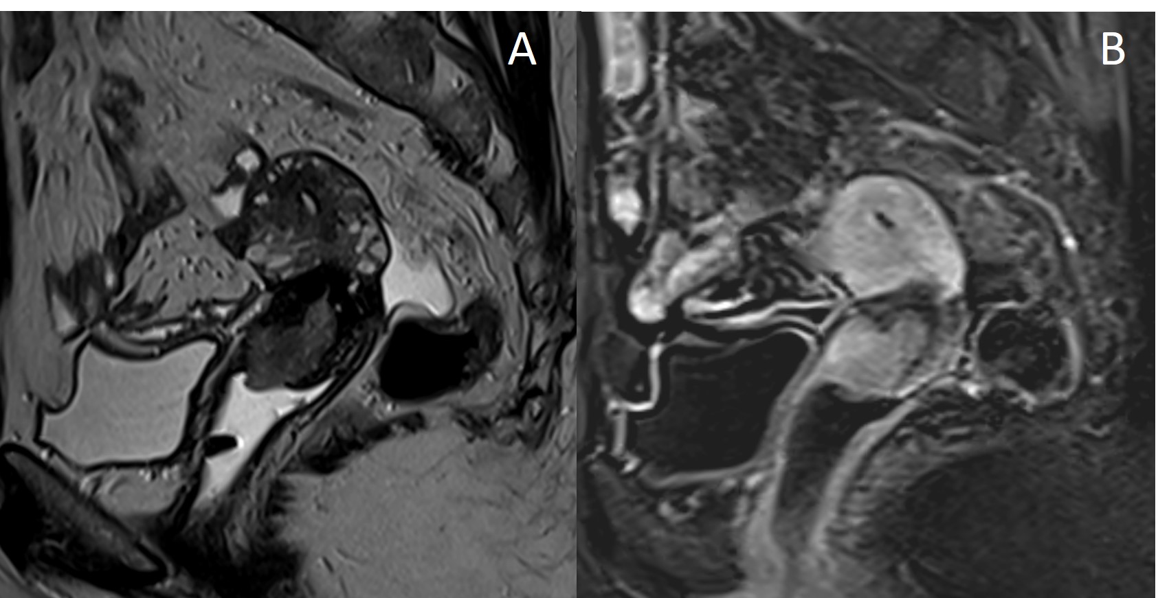 Adenocarcinoma do colo uterino. Achadas da ressonância magnética.