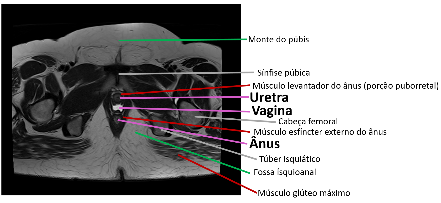 RM perineo