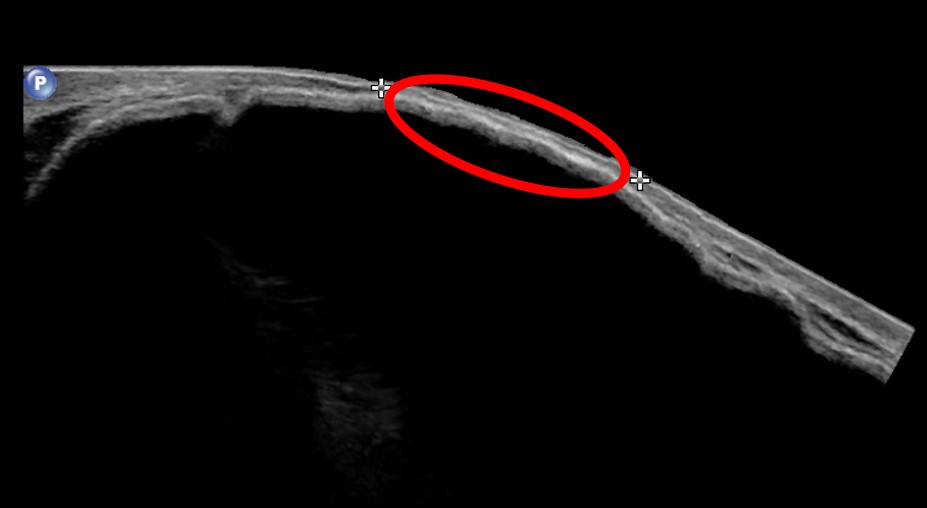 Aspectos clínicos e ultrassonográficos da extrusão de prótese mamária
