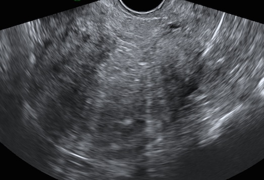 Aspectos ultrassonográficos da adenomiose