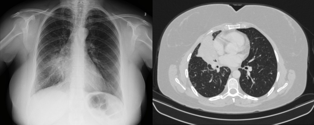 Atelectasia do lobo médio secundária a metástase de câncer de mama