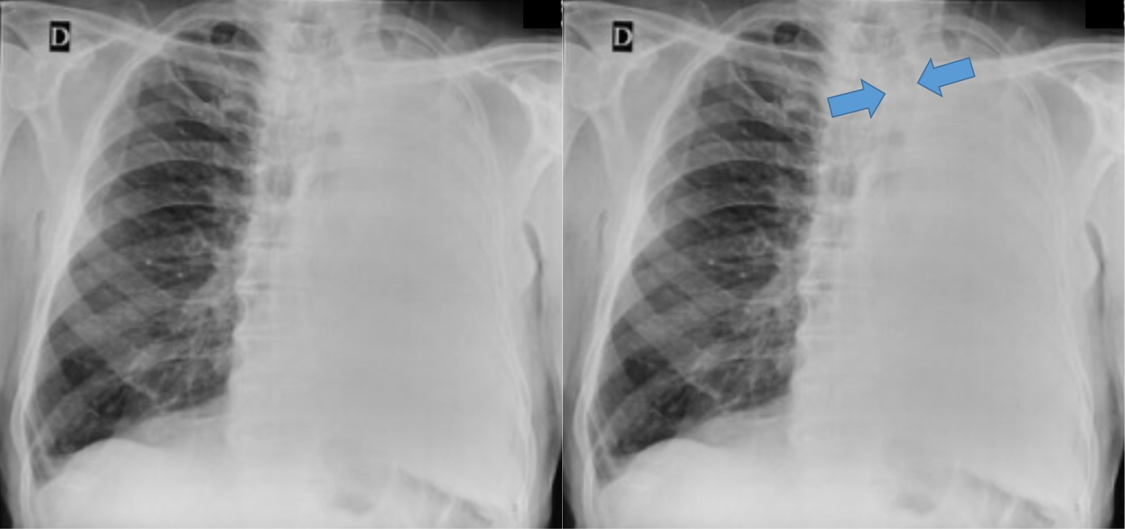 Avaliação de hemitórax opaco à radiografia simples de tórax
