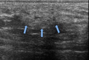Axillary ectopic breast tissue