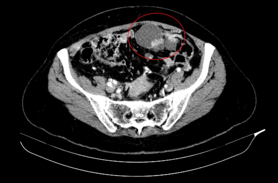 Biópsia de recidiva peritoneal de carcinoma de ovário