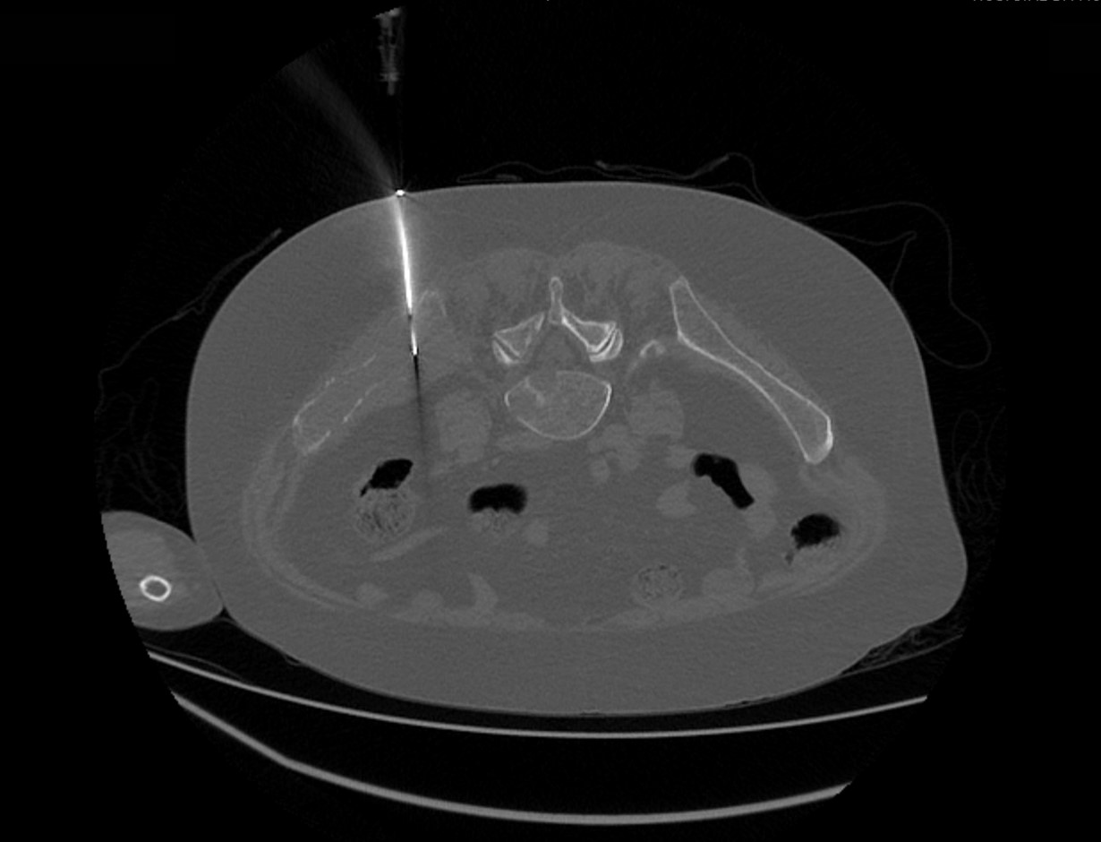 Biópsia de lesão no ilíaco esquerdo orientada pela tomografia computadorizada.