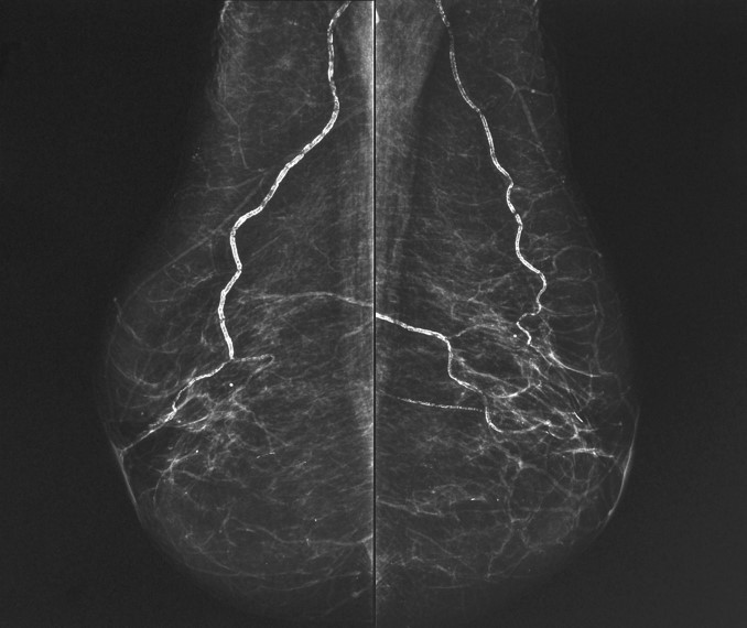Calcificações arteriais mamárias: correlação clínica e mamográfica