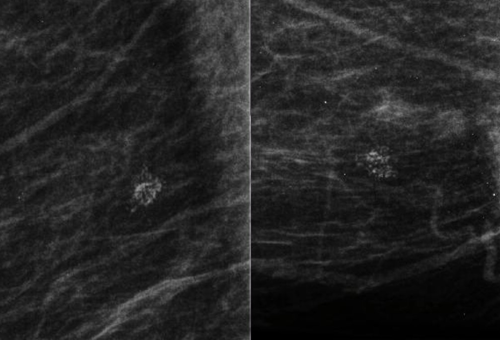 Calcificações cutâneas benignas