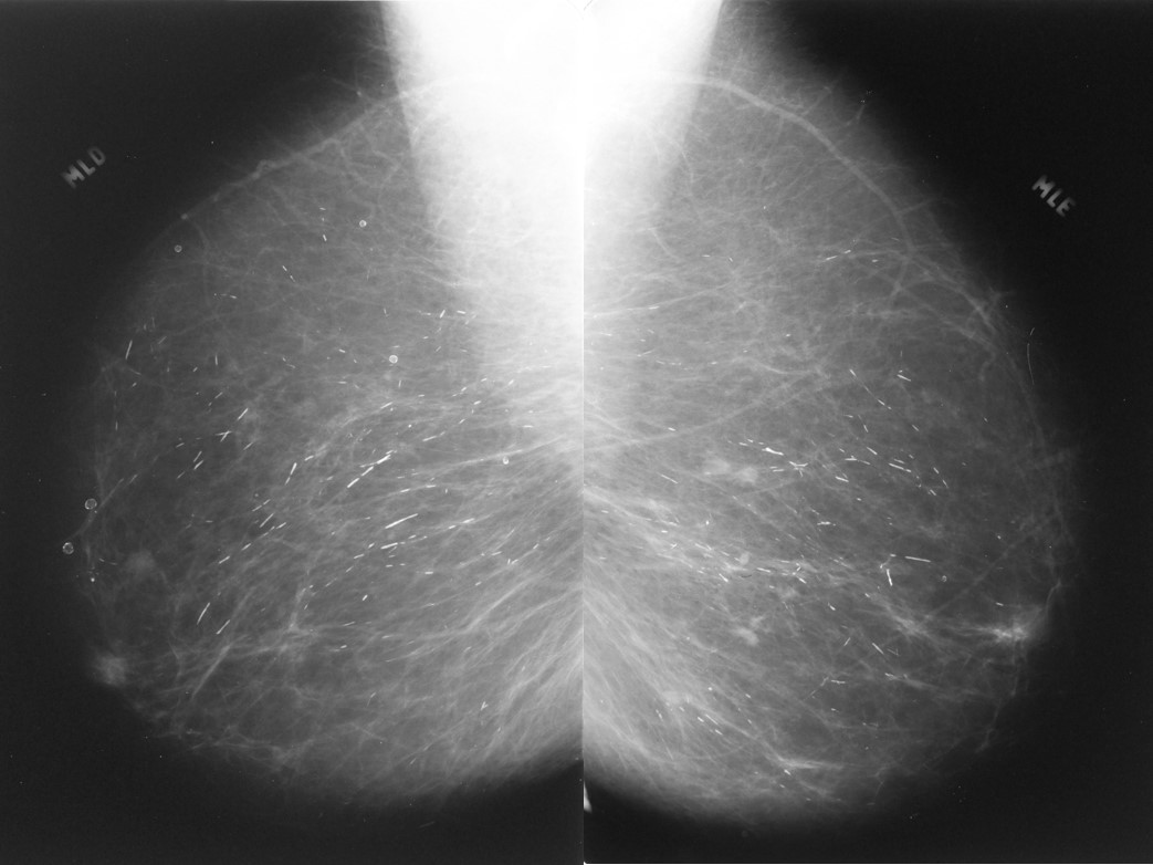 Calcificações ductais em bastão: correlação clínica e mamográfica
