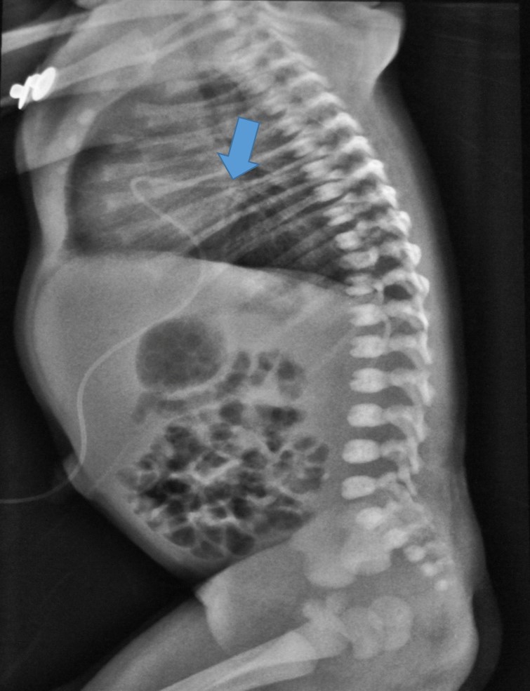 Cateter umbilical venoso mal locado, no átrio esquerdo.