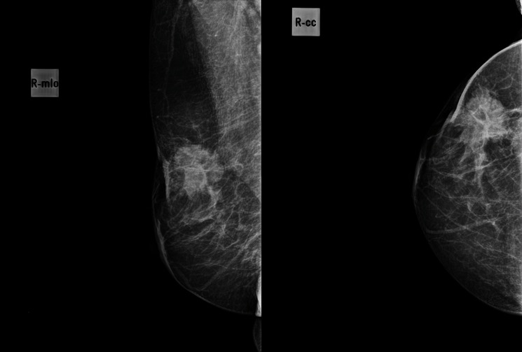 Cdi de mama com retração da pele e do músculo peitoral