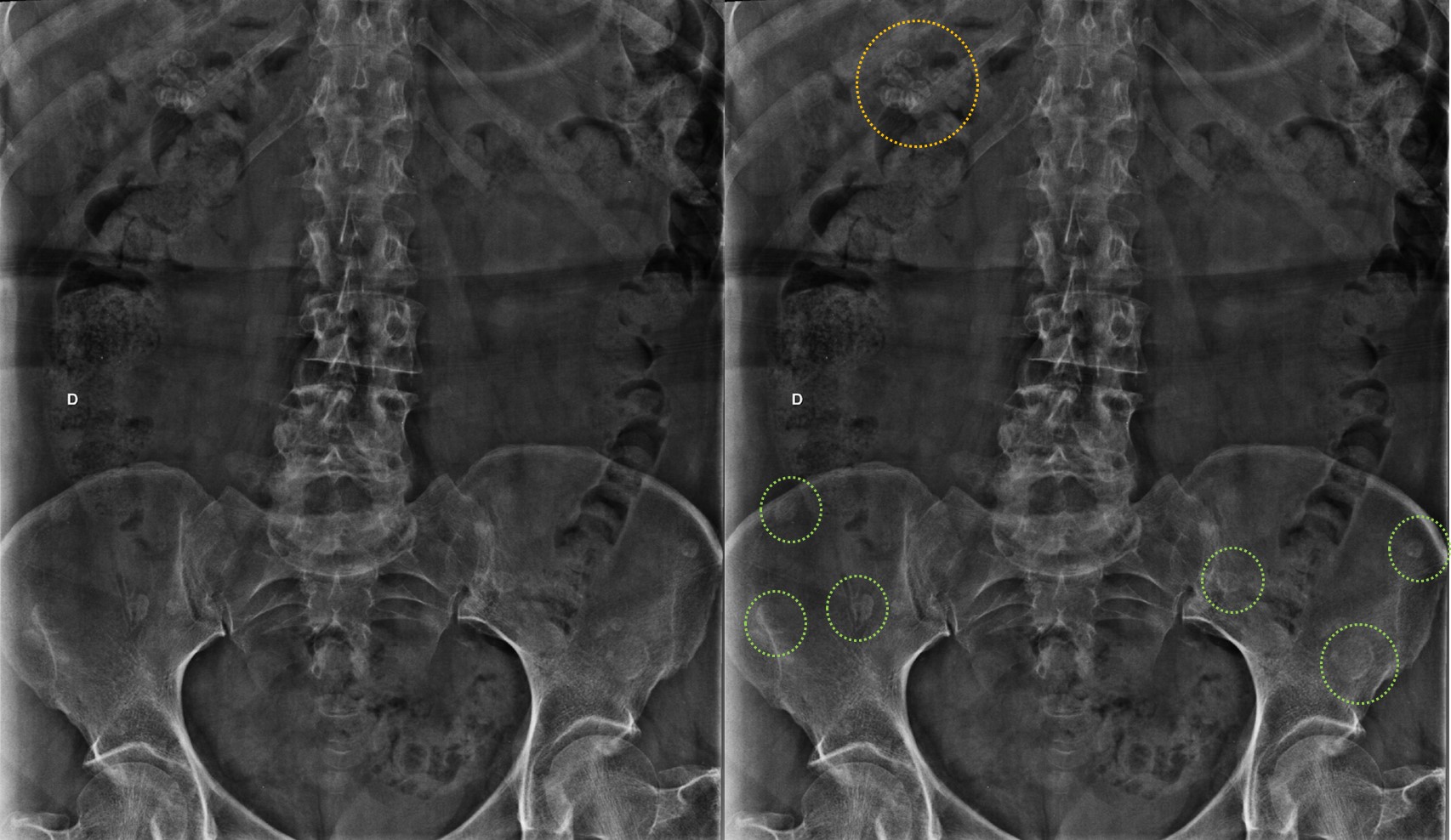 Colelitíase e metástases ósseas ao raio-x da coluna