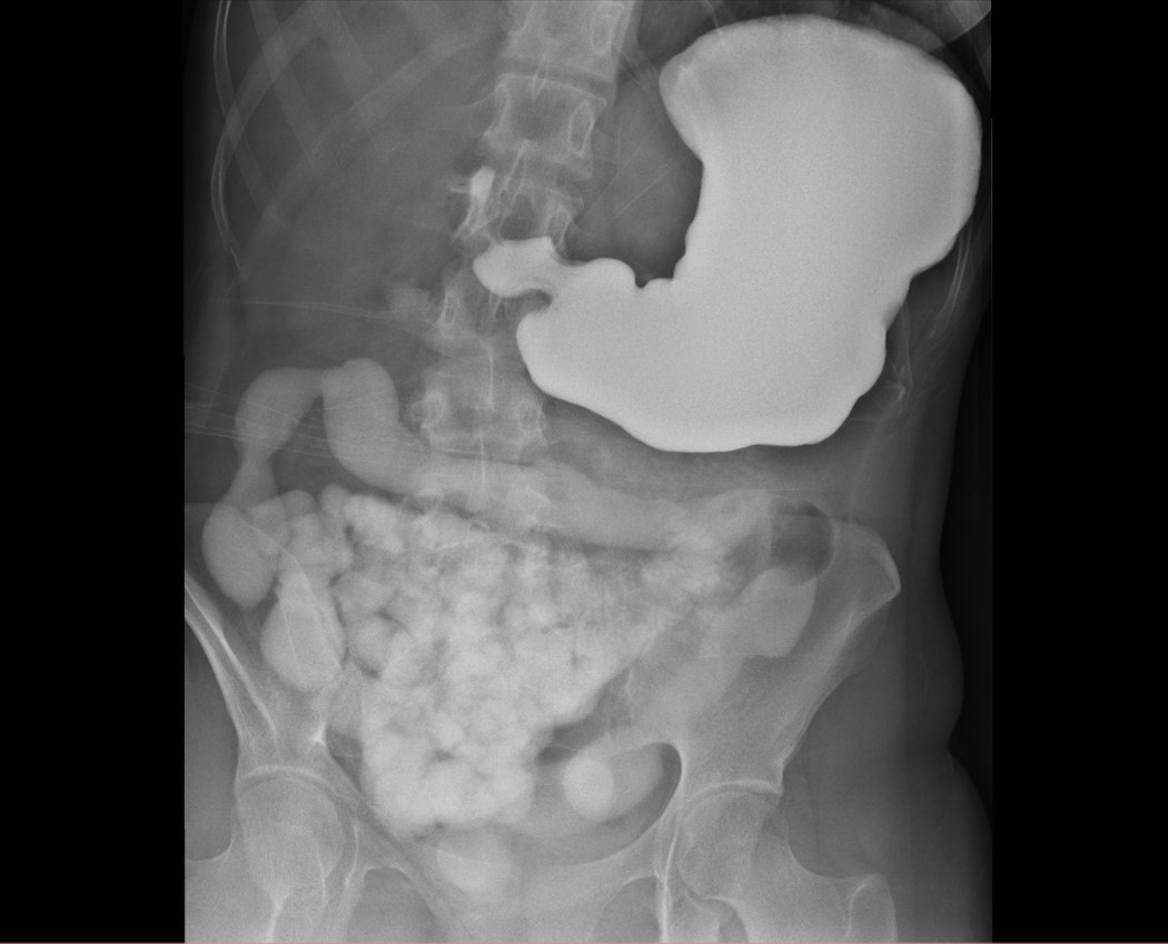 Cólon em "cano-de-chumbo" - retocolite ulcerativa