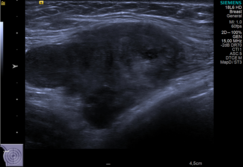 Conglomerado linfonodal axilar