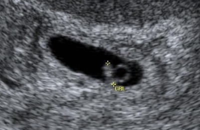 Critérios para diagnóstico de gestação tópica inviável