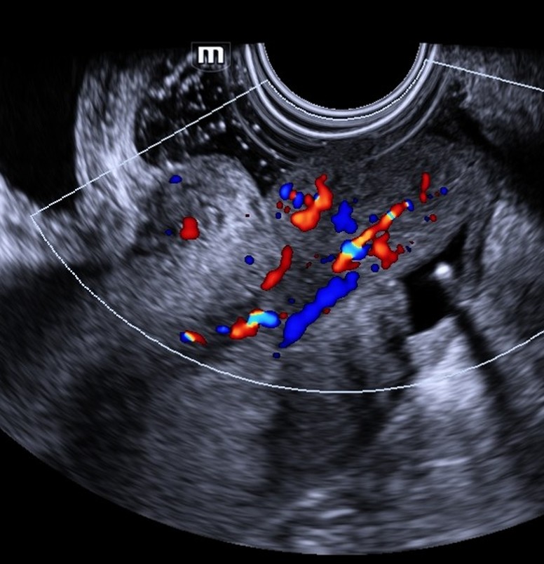 Delivered myoma. Classical ultrasound findings.