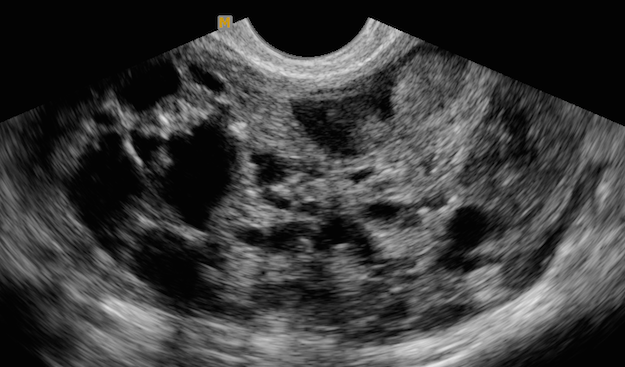 Descrição ultrassonográfica das massas anexiais segundo iota