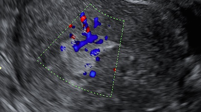 Descrição ultrassonográfica dos achados endometriais - ieta