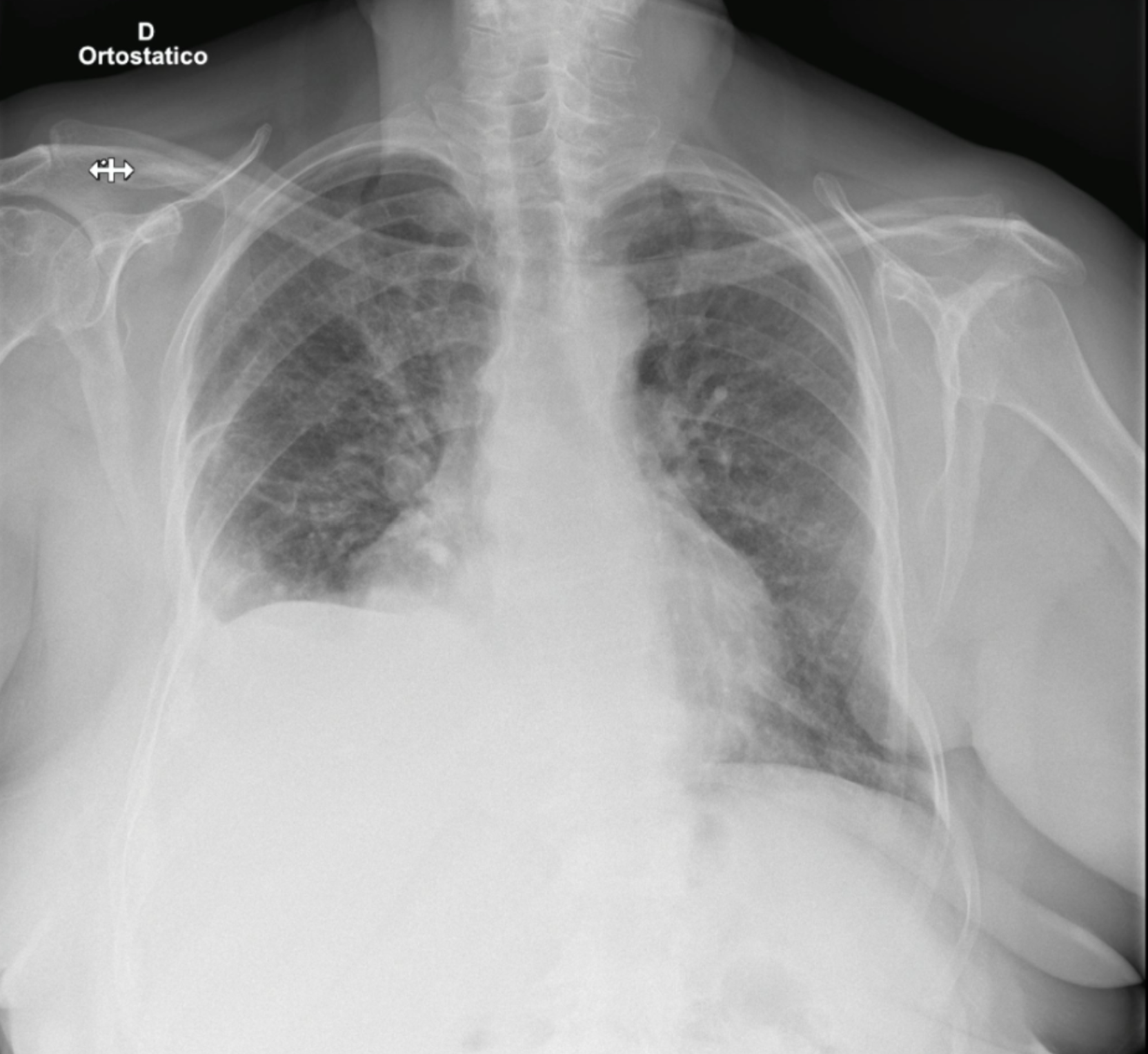 torax_derramepleural