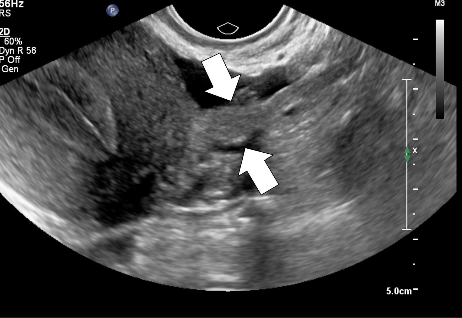 Endometriose_Ligamento_Redondo_Esquerdo