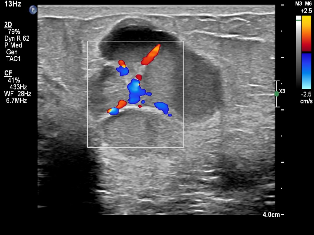 carcinoma_mpilifero_USmama