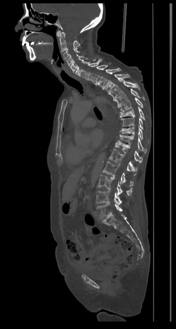 fraturas patologicas_multiplas_metas_osseas