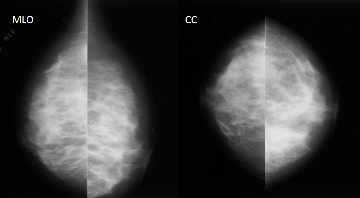 Diagnósticos mamográfico e ultrassonográfico falsos negativos: relato de caso.