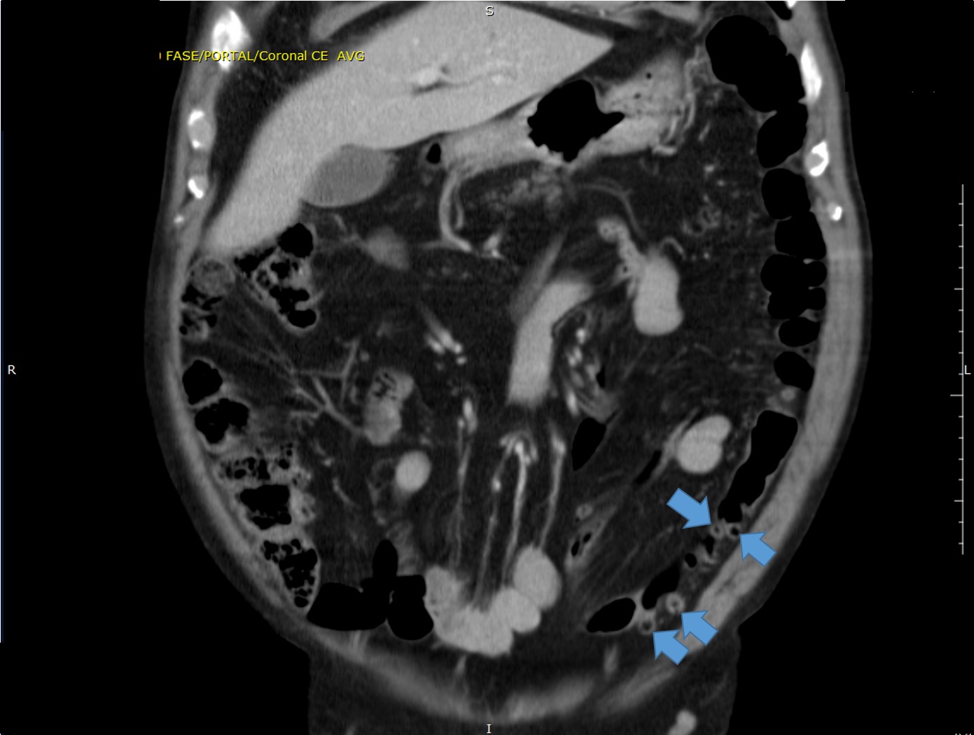 Diverticular disease