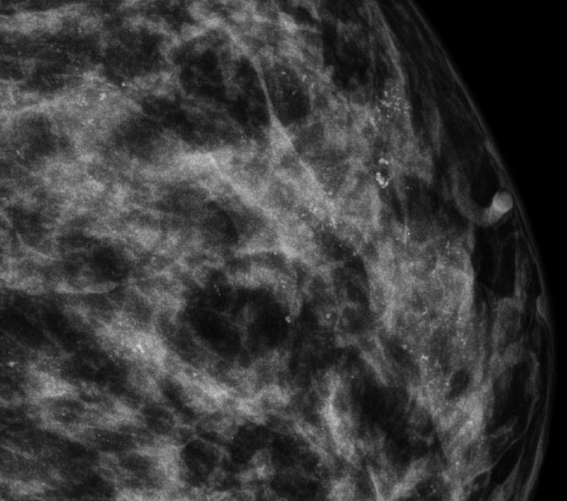 Doença de paget da papila