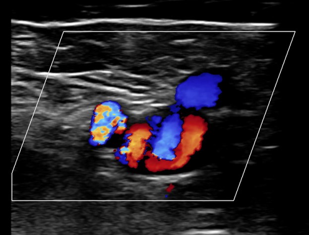 Doppler de membros inferiores - Cabeça do Mickey