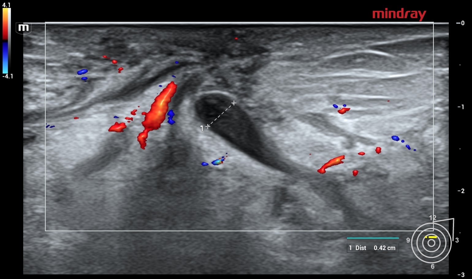 Ectasia ductal preenchida por líquido espesso em paciente com mastite