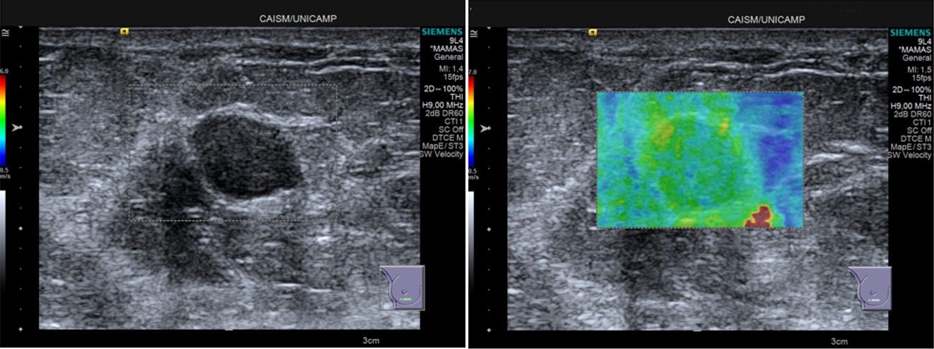 Elastografia de nódulo mamário benigno