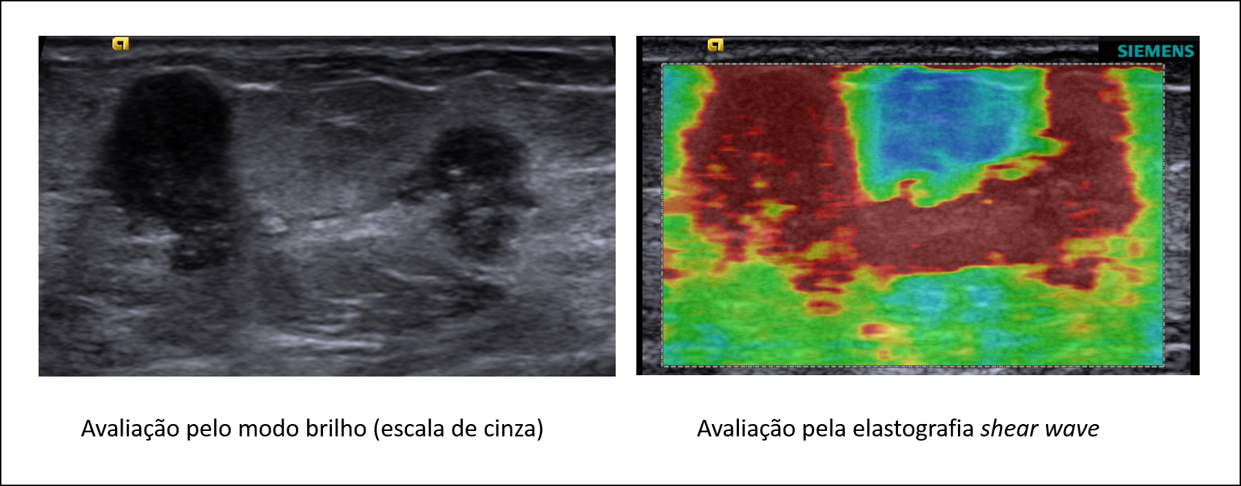 Elastografia de tumor multifocal da mama