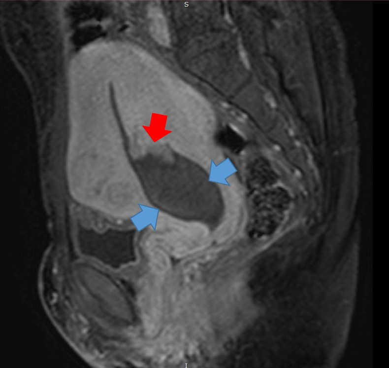 Ensaio pictórico - mioma uterino submucoso parido