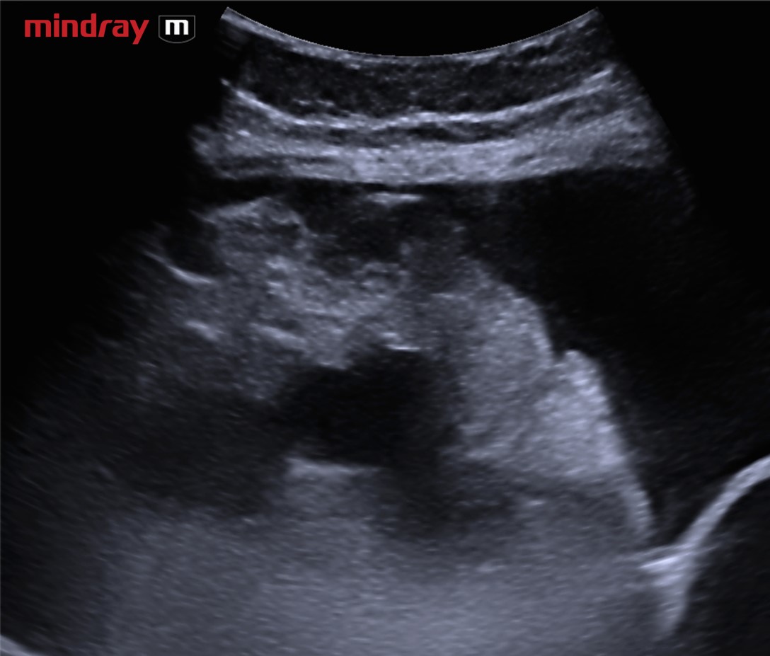Espessamento epiploico por carcinomatose peritoneal