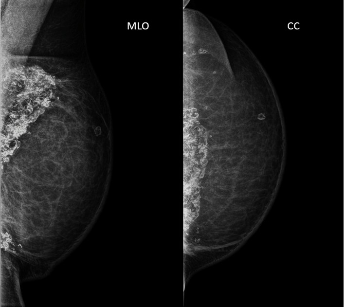 Esteatonecrose em exames por imagem da mama