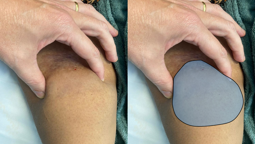 Extravasation  of iodinated contrast at the puncture site on computed tomography scan.