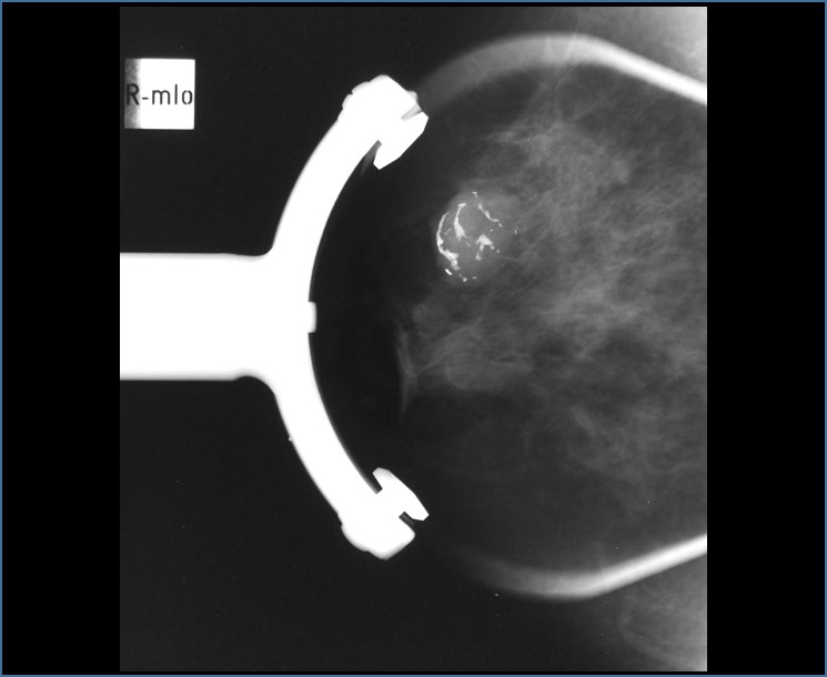 Fibroadenoma calcificado – relato de caso