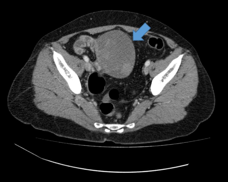 Fibroma ovariano torcido