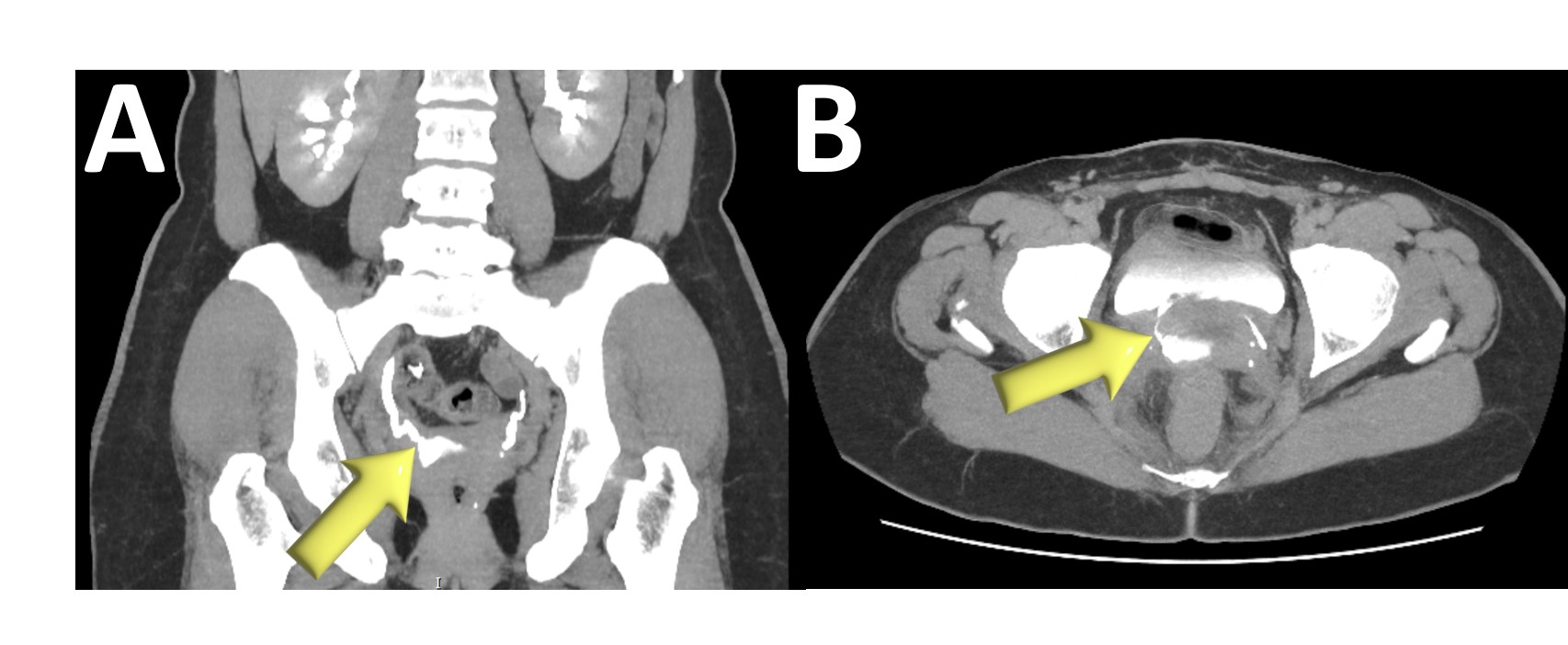 Fístula uretero-vaginal