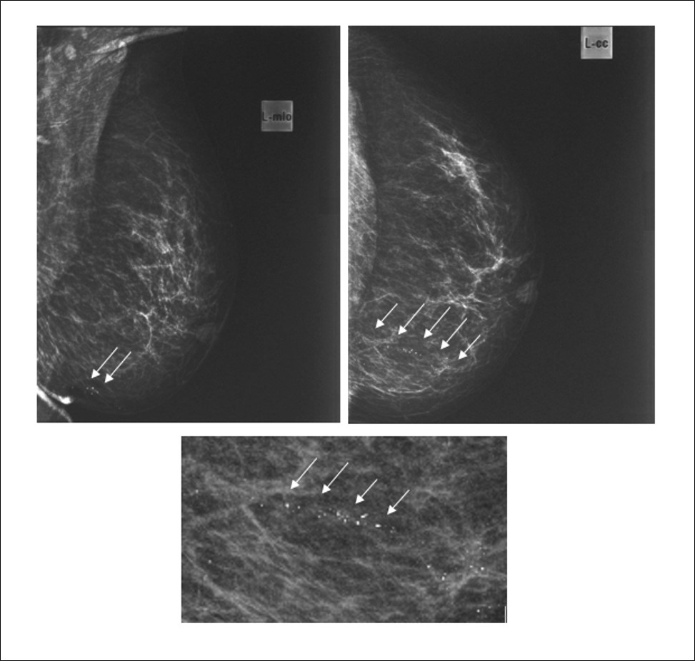 Fragmentos metálicos de projétil de arma de fogo sugerindo calcificações suspeitas na mamografia