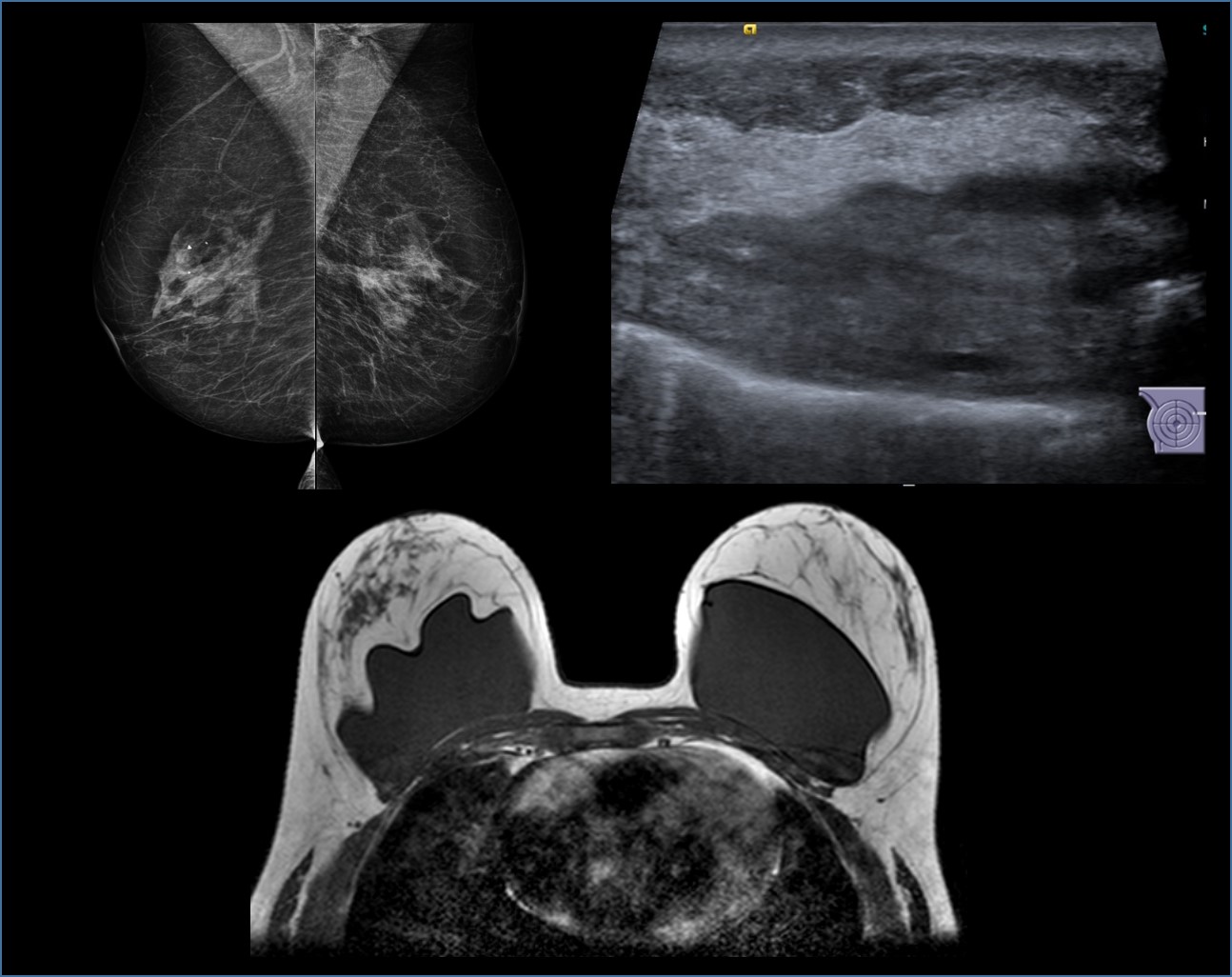 Fundamentos da propedêutica por imagem da mama - Terceiro ano da medicina