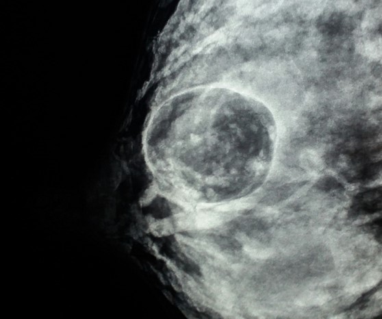 Galactocele com ecotextura aparentemente sólida - relato de caso